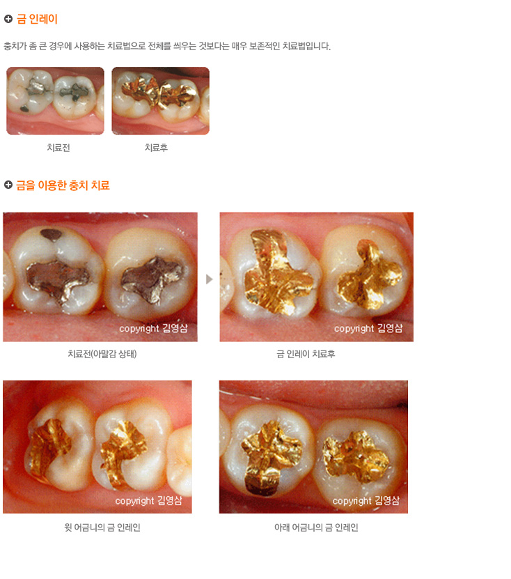 금인레이
충치가 좀 큰 경우에 사용하는 치료법으로 전체를 씌우는 것보다는 매우 보존적인 치료법입니다.