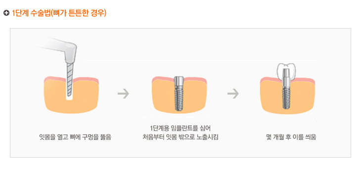 1단계 수술법(뼈가 튼튼한 경우)
	 1. 잇몸을 열고 뼈에 구멍을 뚫음
	 2. 1단계용 임플란트를 심어 처음부터 잇몸 밖으로 노출시킴
	 3. 몇 개월 후 이를 씌움