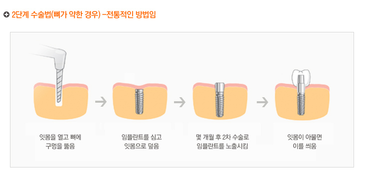 2단계 수술법(뼈가 약한 경우) -전통적인 방법임
1. 잇몸을 열고 뼈에 구멍을 뚫음
2. 임플란트를 심고 잇몸으로 덮음
3. 몇 개월 후 2차 수술로 임플란트를 노출시킴
4. 잇몸이 아물면 이를 씌움