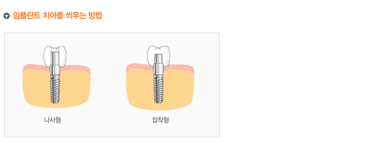 임플란트 치아를 씌우는 방법
	 나사형, 집착형