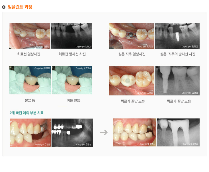 임플란트 과정
 본을 뜸 --> 이를 만듦 --> 치료가 끝난 모습