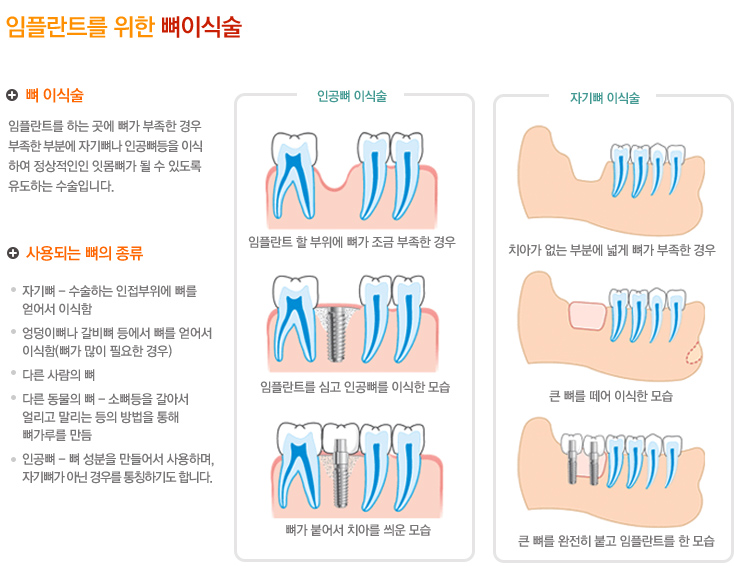 임플란트를 위한 뼈 이식술
	뼈 이식술
	임플란트를 하는 곳에 뼈가 부족한 경우 부족한 부분에 자기뼈나 인공뼈등을 이식하여 정상적인인 잇몸뼈가 될 수 있도록 유도하는 수술입니다.
	사용되는 뼈의 종류류
	자기뼈 - 수술하는 인접부위에 뼈를 얻어서 이식함
    엉덩이뼈나 갈비뼈 등에서 뼈를 얻어서 이식함(뼈가 많이 필요한 경우)
    다른 사람의 뼈
    다른 동물의 뼈 - 소뼈등을 갈아서 얼리고 말리는 등의 방법을 통해 뼈가루를 만듬
    인공뼈 - 뼈 성분을 만들어서 사용하며,자기뼈가 아닌 경우를 통칭하기도 합니다.