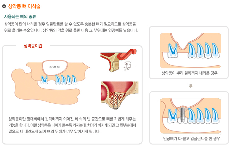 상악동 뼈 이식술
사용되는 뼈의 종류
상악동이 많이 내려온 경우 임플란트를 할 수 있도록 충분한 뼈가 필요하므로 상악동을 
위로 올리는 수술입니다. 상악동의 막을 위로 올린 다음 그 부위에는 인공뼈를 넣습니다.

상악동이란 광대뼈에서 윗턱뼈까지 이어진 뼈 속의 빈 공간으로 뼈를 가볍게 해주는 
기능을 합니다. 이런 상악동은 나이가 들수록 커지는데, 치아가 빠지게 되면 그 윗부분에서 
밑으로 더 내려오게 되어 뼈의 두께가 너무 얇아지게 됩니다.
