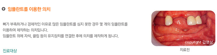 임플란트를 이용한 의치
	뼈가 부족하거나 경제적인 이유로 많은 임프란트를 심지 못한 경우 몇 개의 임프란트를 
    이용하여 제작하는 의치입니다.
    임플란트 위에 자석, 클립 등의 유지장치를 연결한 후에 의치를 제작하게 됩니다.