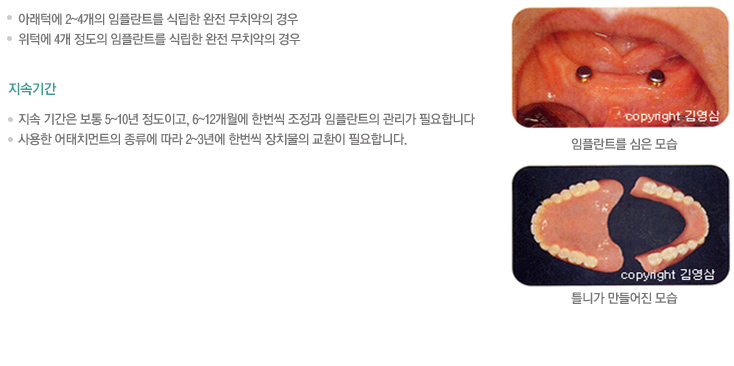 진료대상
아래턱에 2~4개의 임플란트를 식립한 완전 무치악의 경우
위턱에 4개 정도의 임플란트를 식립한 완전 무치악의 경우 

지속기간
지속 기간은 보통 5~10년 정도이고, 6~12개월에 한번씩 조정과 임플란트의 관리가 필요합니다
사용한 어태치먼트의 종류에 따라 2~3년에 한번씩 장치물의 교환이 필요합니다.