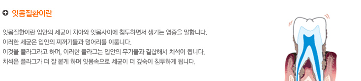 잇몸질환이란
잇몸질환이란 입안의 세균이 치아와 잇몸사이에 침투하면서 생기는 염증을 말합니다.
이러한 세균은 입안의 찌꺼기들과 덩어리를 이룹니다.
이것을 플라그라고 하며, 이러한 플라그는 입안의 무기물과 결합해서 치석이 됩니다.
치석은 플라그가 더 잘 붙게 하며 잇몸속으로 세균이 더 깊숙이 침투하게 됩니다.