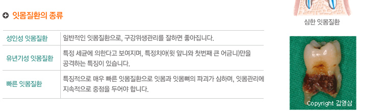 잇몸질환의 종류
성인성 잇몸질환 - 일반적인 잇몸질환으로, 구강위생관리를 잘하면 좋아집니다.
유년기성 잇몸질환 - 특정 세균에 의한다고 보여지며, 특정치아(윗 앞니와 첫번째 큰 어금니)만을 공격하는 특징이 있습니다. 
빠른 잇몸질환  - 특징적으로 매우 빠른 잇몸질환으로 잇몸과 잇몸뼈의 파괴가 심하며, 잇몸관리에 지속적으로 중점을 두어야 합니다.