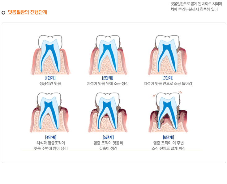 잇몸질환의 단계
1단계 : 정상적인 잇몸 --> 2단계 : 치석이 잇몸 위에 조금 생김 --> 3단계 : 치석이 안으로 조금 들어감 --> 4단계: 치석과 염증 조직이 잇몸 주변에 많이 생김
--> 5단계 : 염증 조직이 잇몸뼈 깊숙이 생김 --> 6단계 : 염증 조직이 이 주변 조직 전체로 넓게 퍼짐