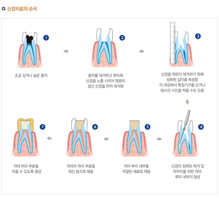 신경치료의 순서
1: 조금 깊거나 넓은 충치 --> 2 : 충치를 제거하고 뿌리족 신경을 노출시켜서 염증이 생긴 신경을 먼저 제거함 --> 3: 신경을 깨끗이 제거하기 위해 정확한 길이를 측정함 
이 과정에서 특정기구를 쓰거나 방사선 사진을 찍을 수도 있음 --> 4: 신경의 정확한 제거 및 마무리를 위한 치아 뿌리 내부의 형성 --> 5 : 치아 뿌리 내부를 적절한 재료로 채움 
--> 6: 치아의 머리 부분을 레진으로 때움 --> 7: 치아 머리 부분을 씌울 수 있도록 형성