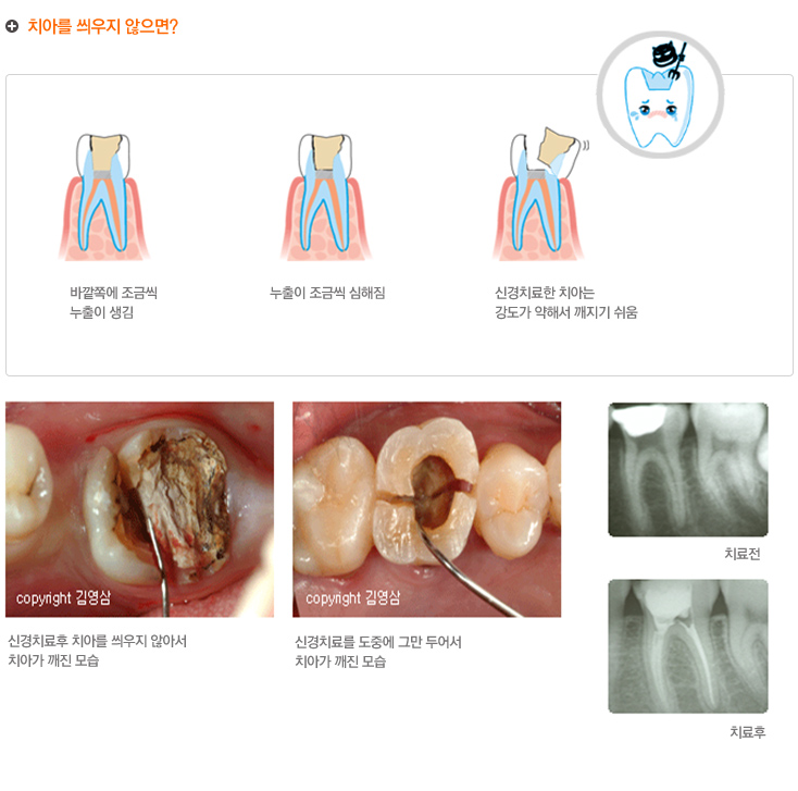 치아를 씌우지 않으면? 
바깥 쪽에 조금씩 누출이 생김
누출이 조금씩 심해짐
신경 치료한 치아는 강도가 약해서 깨지기 쉬움.