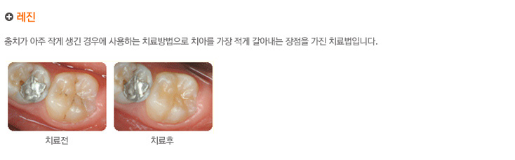 레진
충치가 아주 작게 생긴 경우에 사용하는 치료방법으로 치아를 가장 적게 갈아내는 장점을 가진 치료법입니다