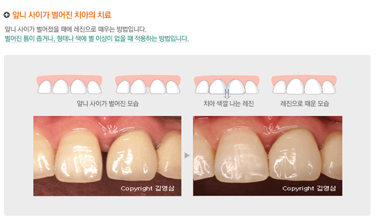 앞니 사이가 벌어진 치아의 치료
앞니 사이가 벌어졌을 때에 레진으로 때우는 방법입니다.
벌어진 틈이 좁거나, 형태나 색에 별 이상이 없을 때 적용하는 방법입니다.
