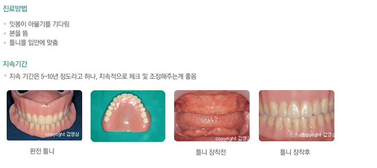 진료방법
    잇몸이 아물기를 기다림
    본을 뜸
    틀니를 입안에 맞춤

지속기간 
    지속 기간은 5~10년 정도라고 하나, 지속적으로 체크 및 조정해주는게 좋음