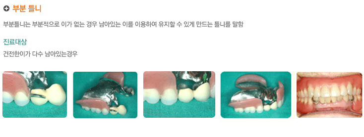 부분 틀니
부분틀니는 부분적으로 이가 없는 경우 남아있는 이를 이용하여 유거할수있게 만든느 틀니를 말함

진료대상
건전한이가 다수 남아있는경우