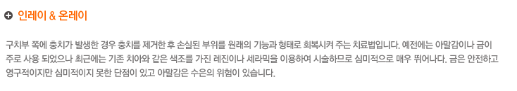 인레이 & 온레이
구치부 쪽에 충치가 발생한 경우 충치를 제거 한 후 손실된 부위를 원래의 기능과 형태로 회복시켜 주는 치료법입니다. 예전에는 아말감이나 금이
주로 사용 되었으나최근에는 기존 치아와같은 색조를 가진 레진이나 세라믹을 이용하여 시술하므로 심미적으로 매우 뛰어나다. 금은 안전하고 
영구적이지만 심미적이지 못한 단점이 있고 아말감은 수은의 위험이 있습니다.