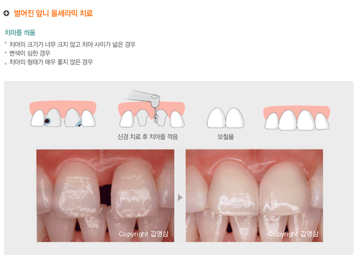 벌어진 앞니 올세라믹 치료
치아를 씌움
치아의 크기가 너무 크지 않고 치아 사이가 넓은 경우
변색이 심한 경우
치아의 형태가 매우 좋지 않은 경우
